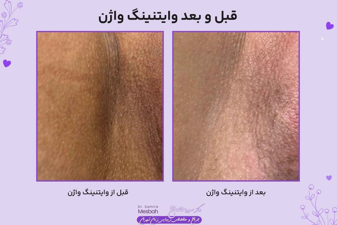 وایتنینگ واژن 1 عکس قبل بعد وایتینگ وازن