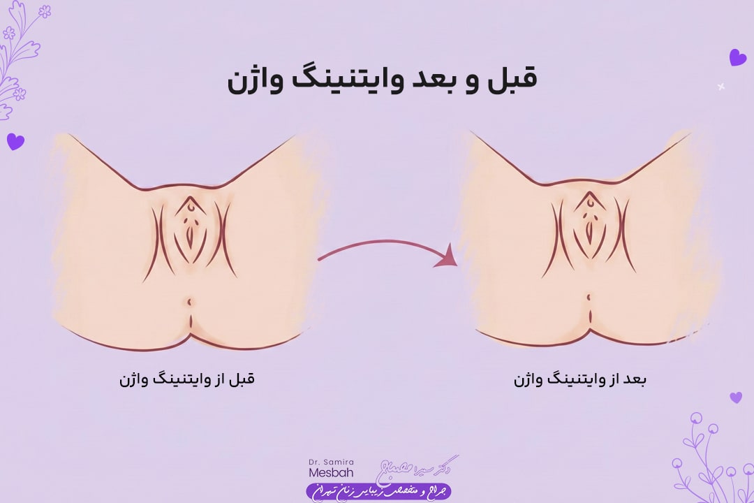 وایتنینگ واژن 2 قبل و بعد سفید کردن واژن